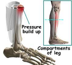 shin splint pain area