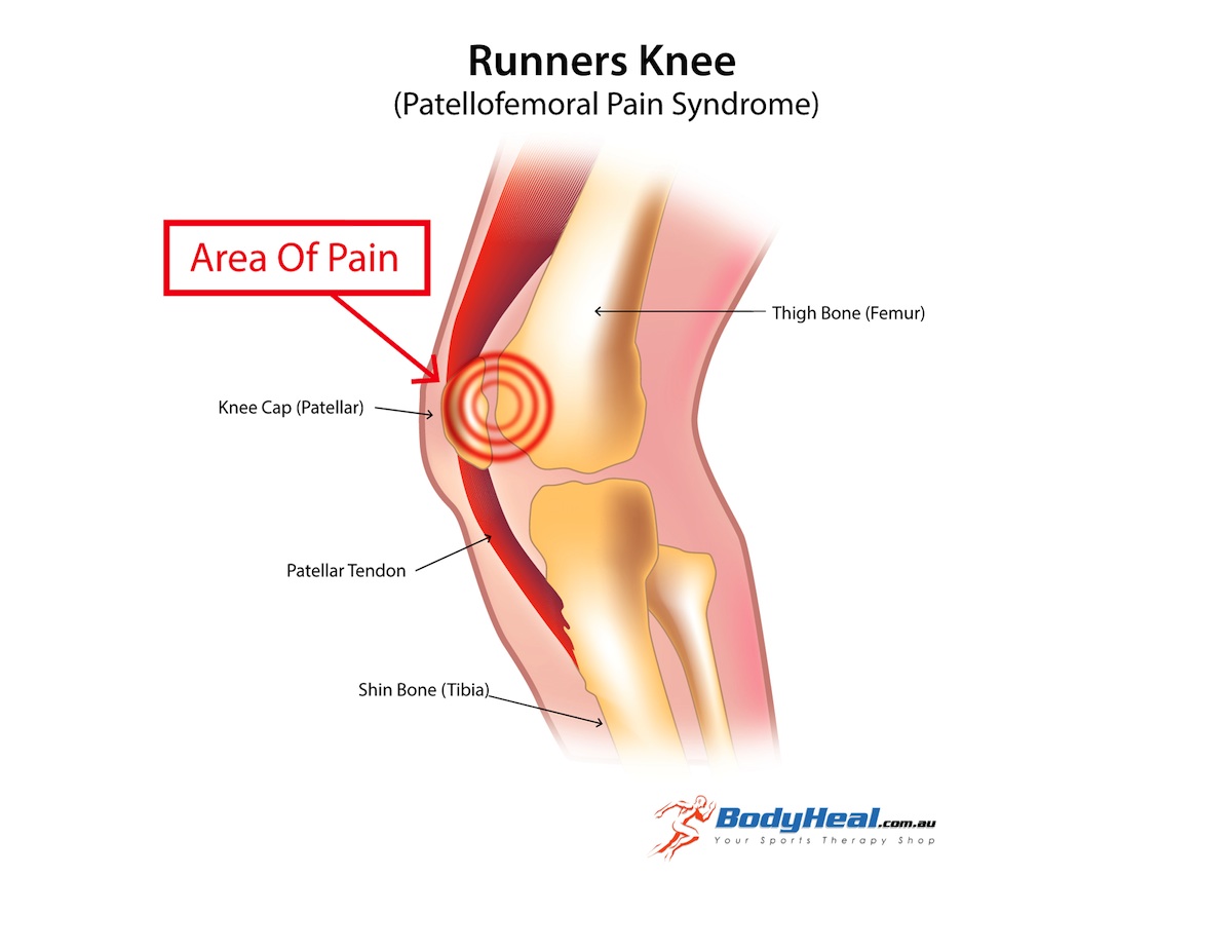 runner's knee pain area