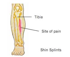 shin splint pain area