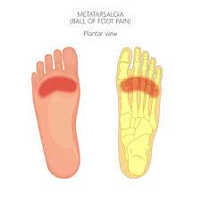 Metatarsalgia pain area