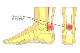 Achilles Tendinopathy pain area