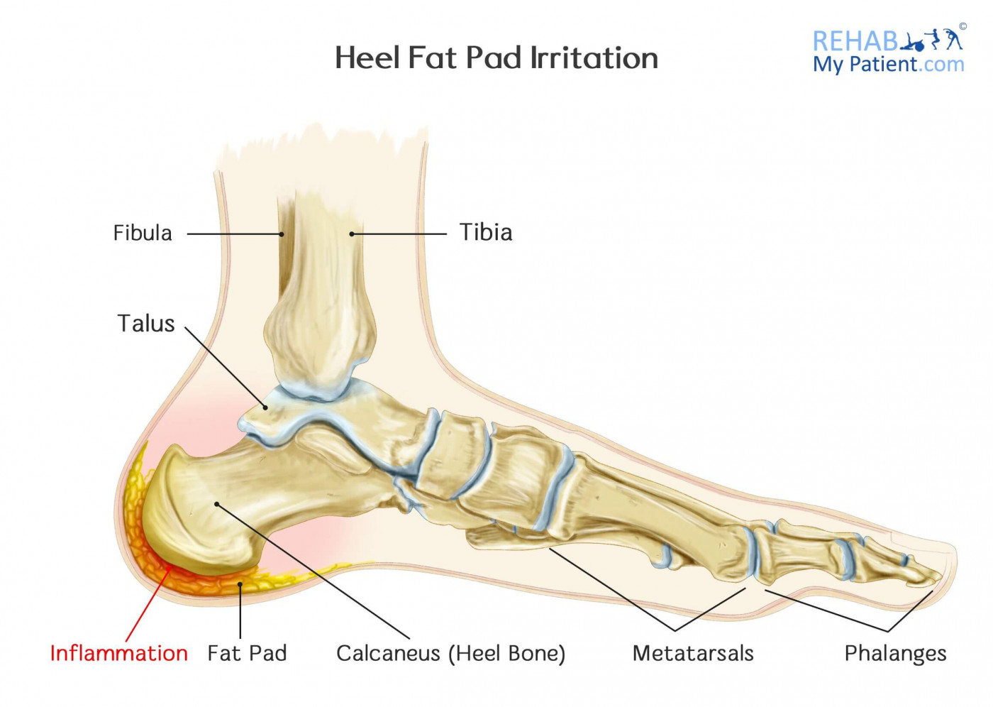 shin splint pain area