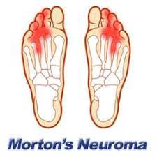 Morton' neuroma pain area