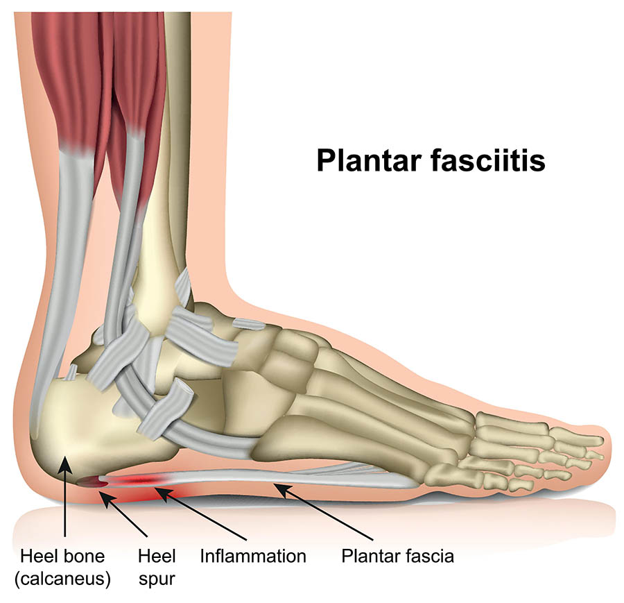 plantar fascia and pain area