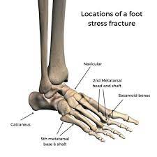 stress fracture pain area