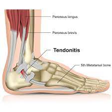 tendonitis pain area